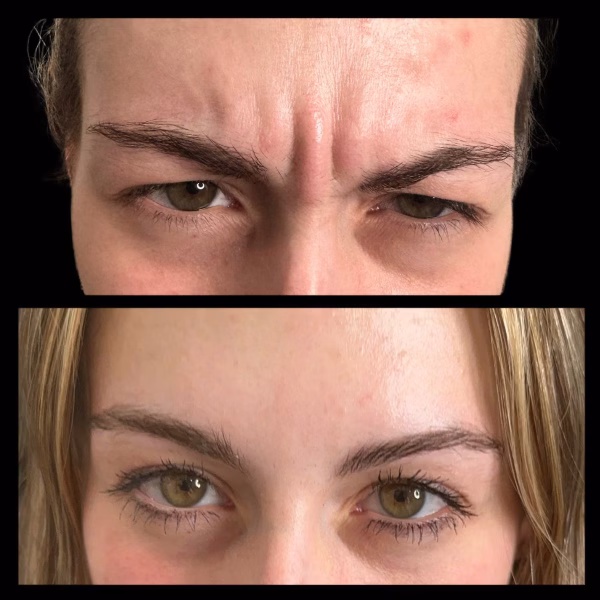 Anti Wrinkle Upper Face