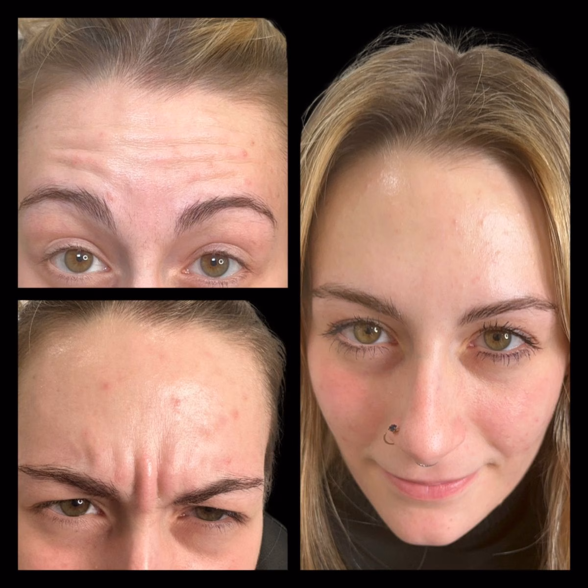 Anti Wrinkle injections Upper Face Tox