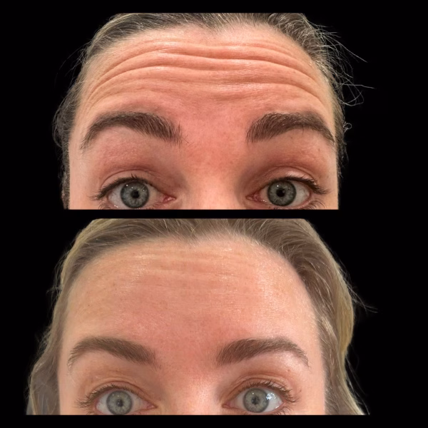 Anti Wrinkleupper face