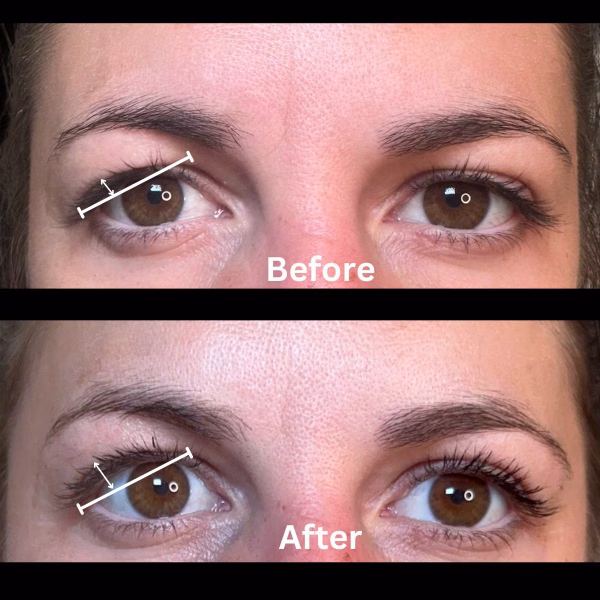 Botox Eyebrow Lift