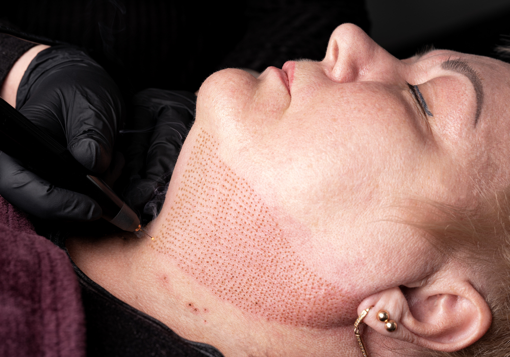 Plasma Fibroblast neck