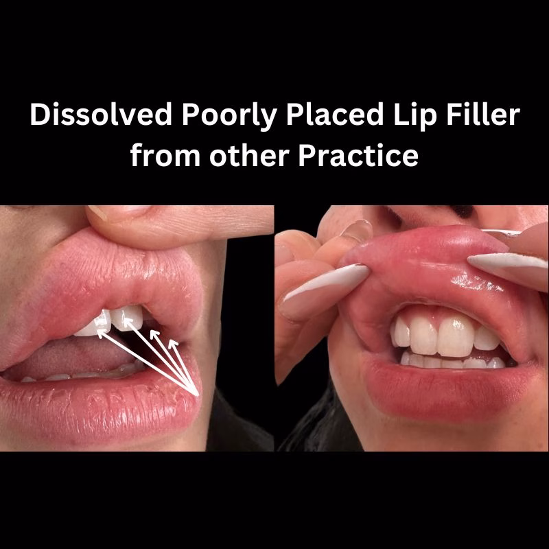 Precise Dermal Filler Dissolver Treatment in Huntington NY