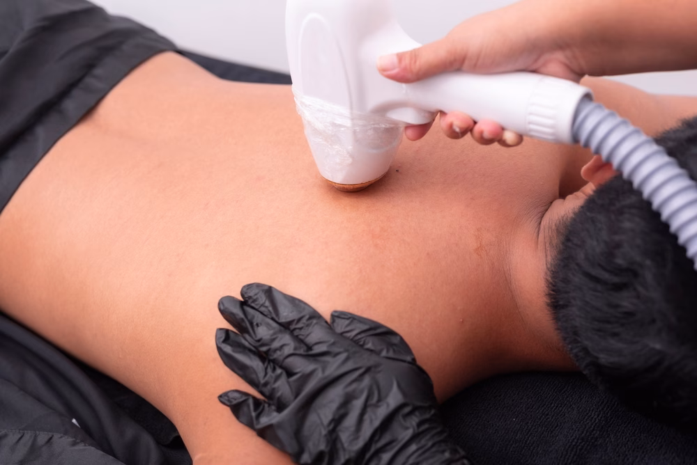 hair removal