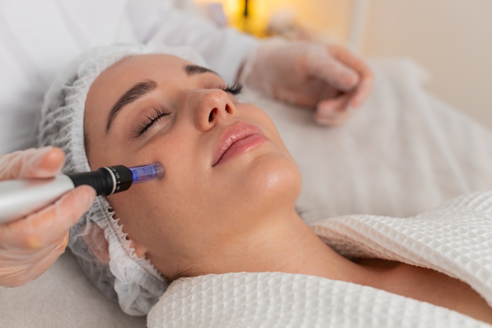 microneedling
