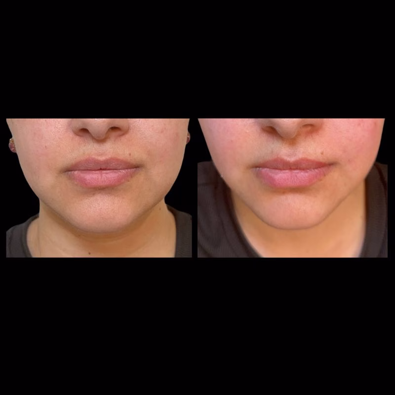 Botox treatment for lower face contouring, jawline slimming & TMJ