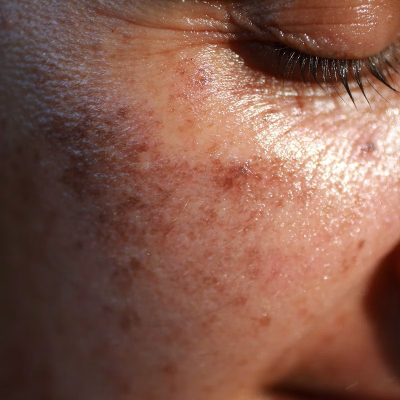 Before and After IPL Pigmentation Treatment in Huntington NY