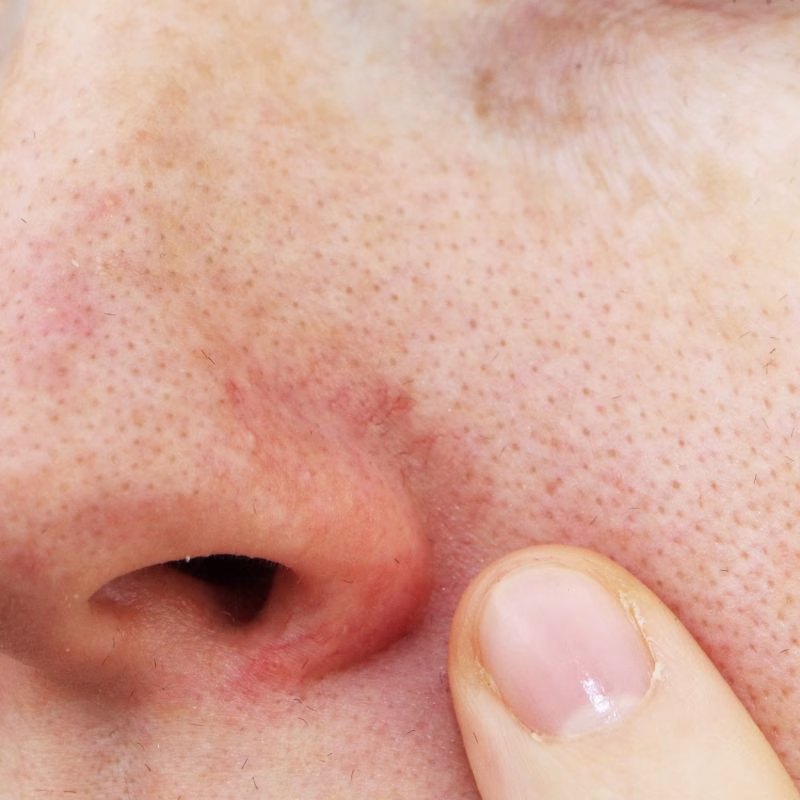 Before and After IPL Treatment for Facial Vascular Concerns in Huntington NY
