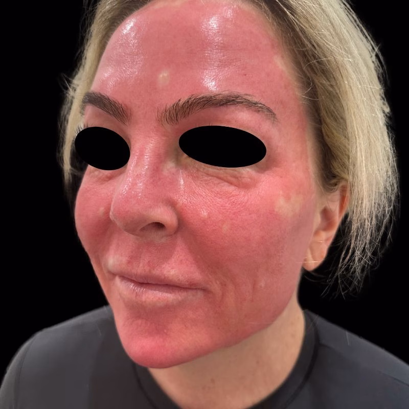 Before and After Plasma Facial Results in Huntington NY