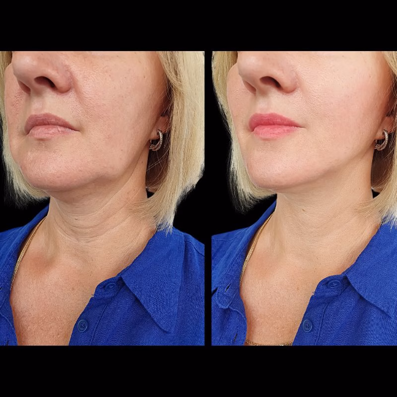 Chin Filler with results by Lysty Aesthetics near Huntington