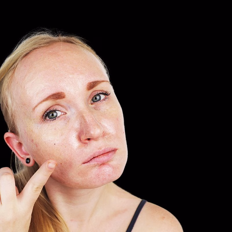 Comfortable IPL Pigmentation Treatments in Huntington NY