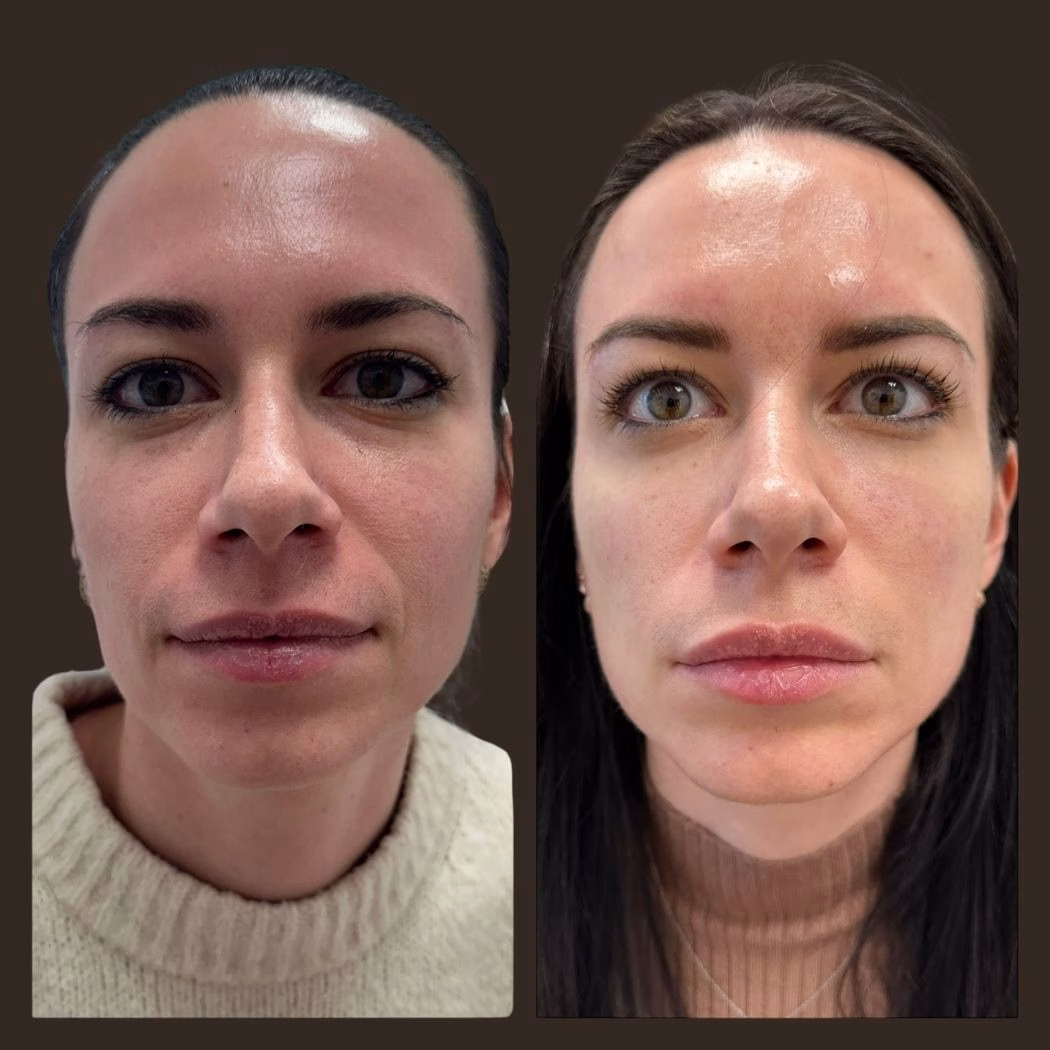 Filler Nasal labial Tear Torugh Filler
