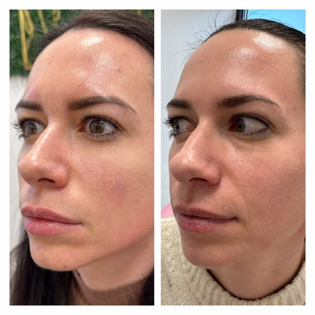 Filler Tear Trough Nasal Labial Fold Filler
