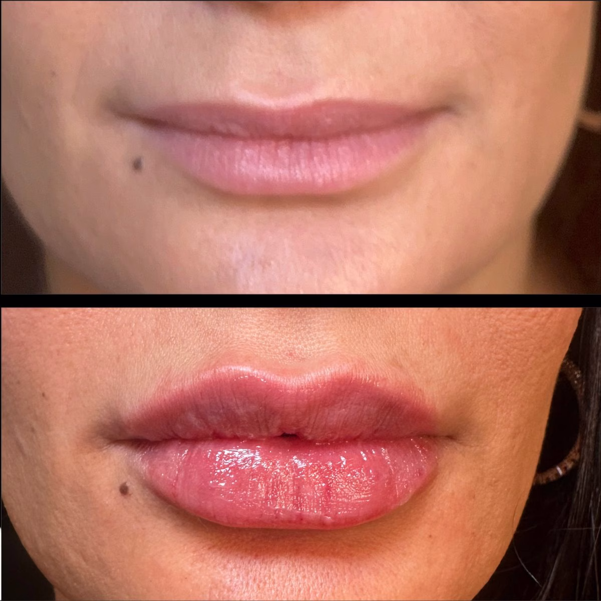 Lip Filler by Lysty Aesthetics & Wellness near Huntington, NY