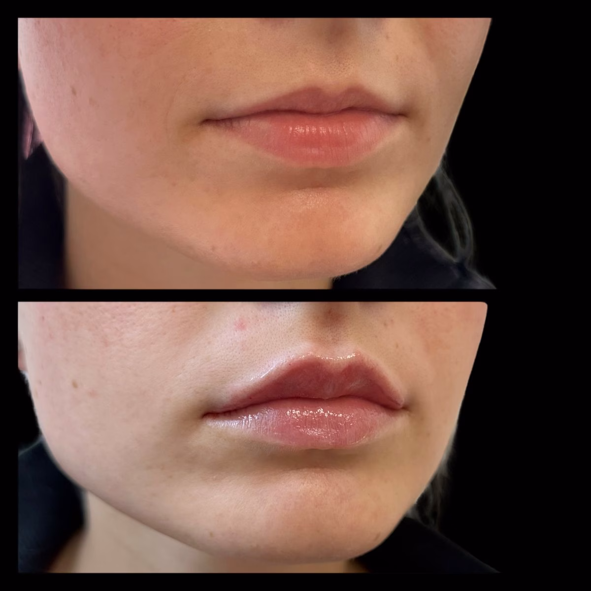 Lip Filler by Lysty Aesthetics & Wellness near near me