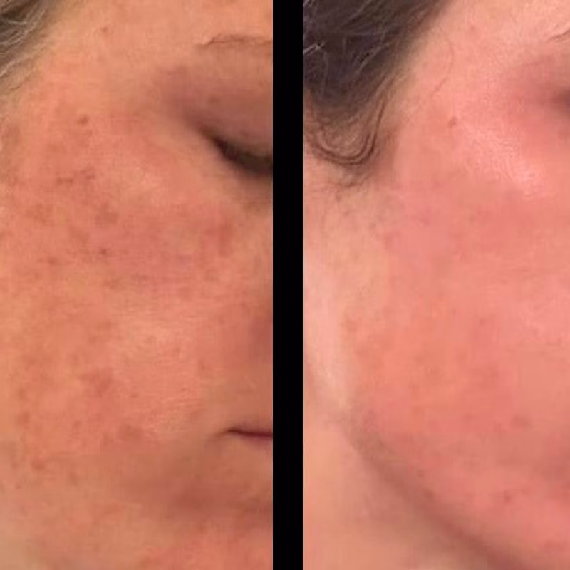 Perfect-Derma-Peel-by-Lysty-Aesthetics-near-Huntington-NY-1