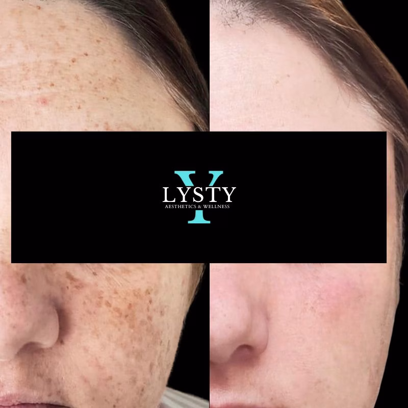 Perfect-Derma-Peel-in-Huntington-NY