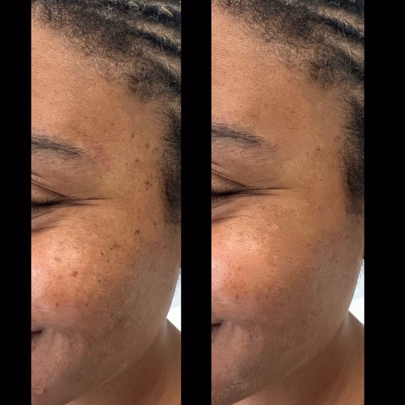 Perfect-Derma-Peel-near-Huntington-Long-Island