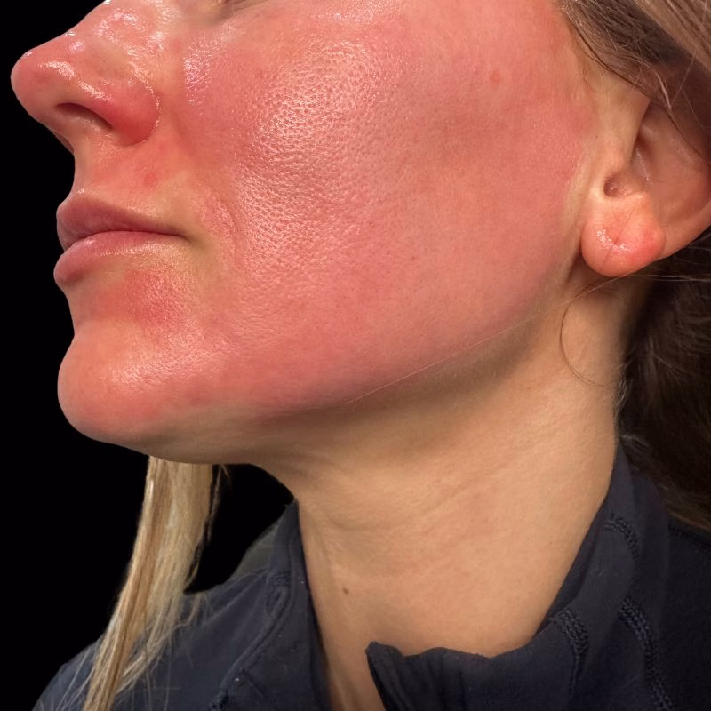 Relaxing Plasma Facial Rejuvenation in Huntington NY