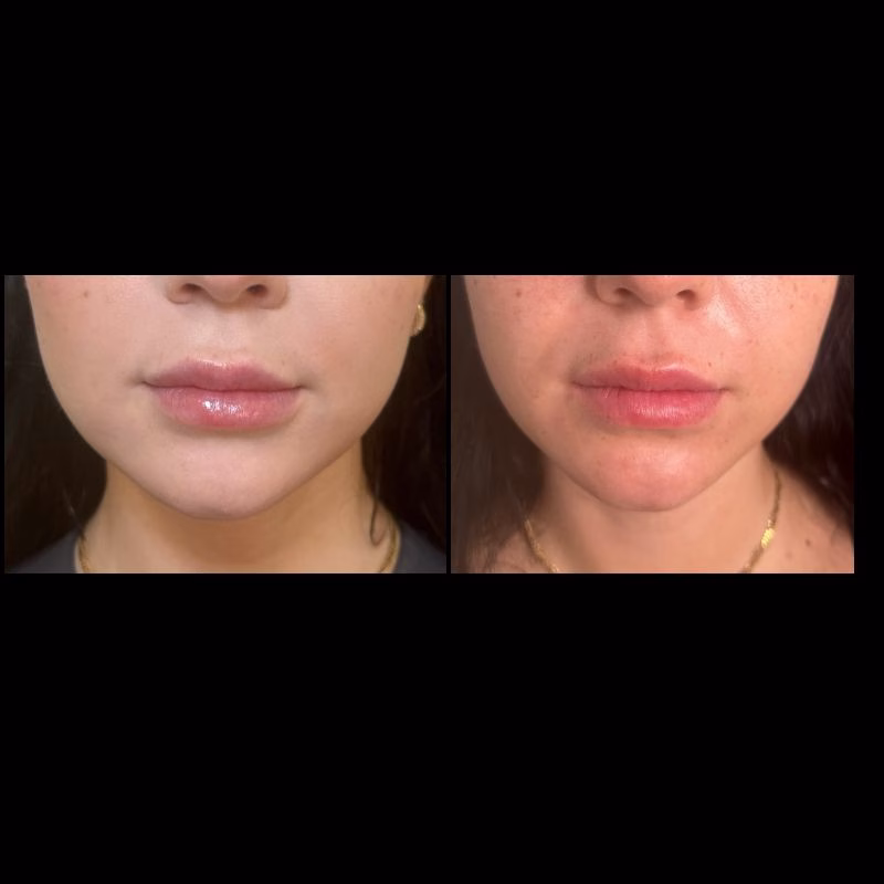 Botox treatment for TMJ, masseter muscle slimming, and teeth grinding relief