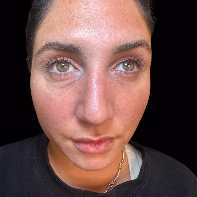 Tear Trough Filler Candidate near Huntington