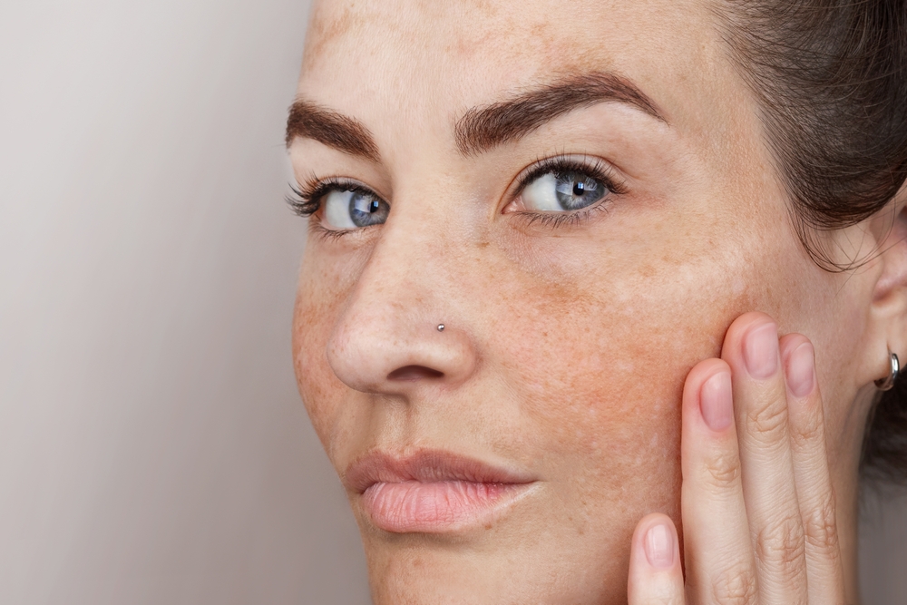 age spots