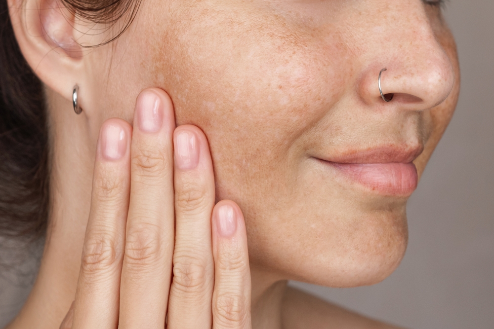 dark spots