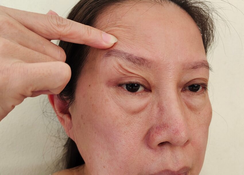 face sagging