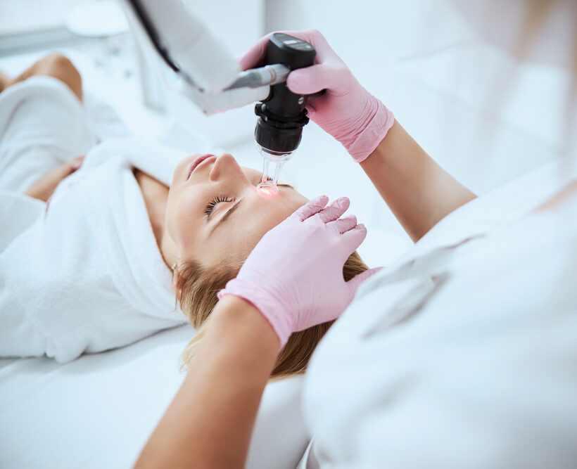 fractional laser