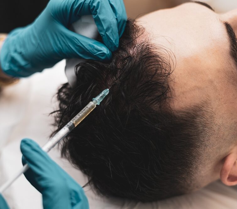 Gloved hands injecting a syringe into a man's scalp for hair treatment.