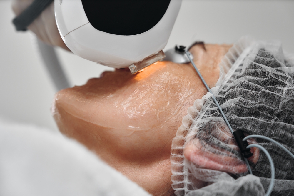 vascular removal