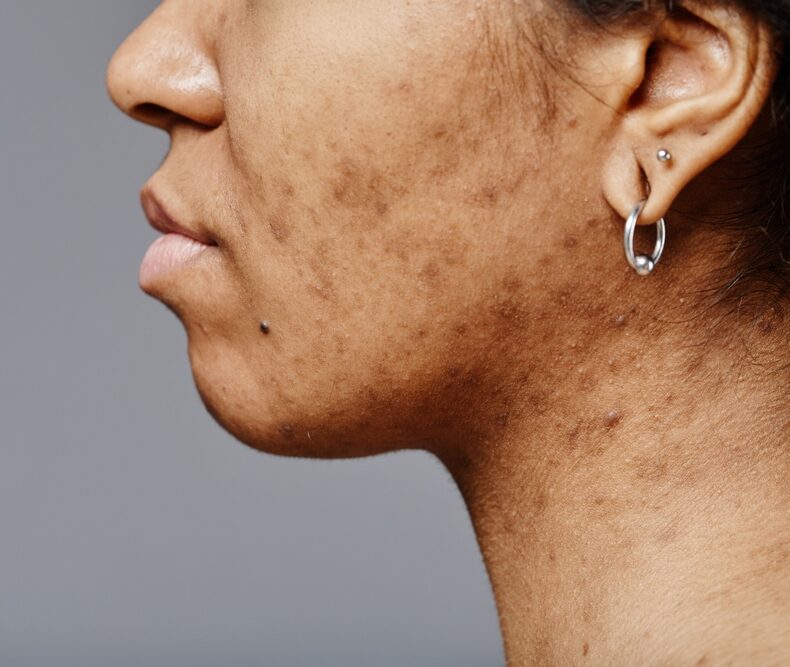 pigmentation