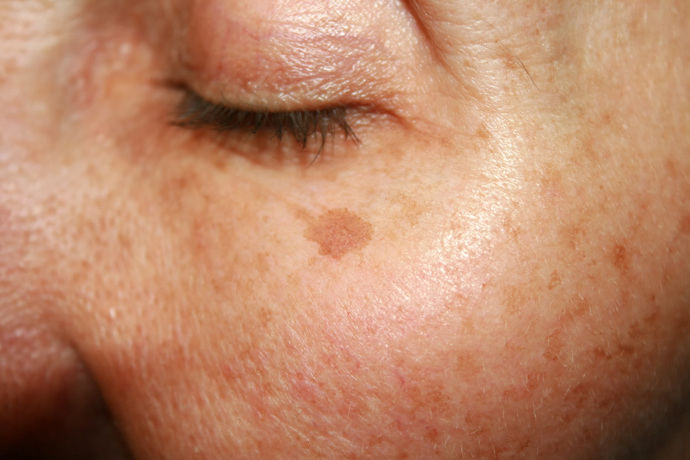 sun spots