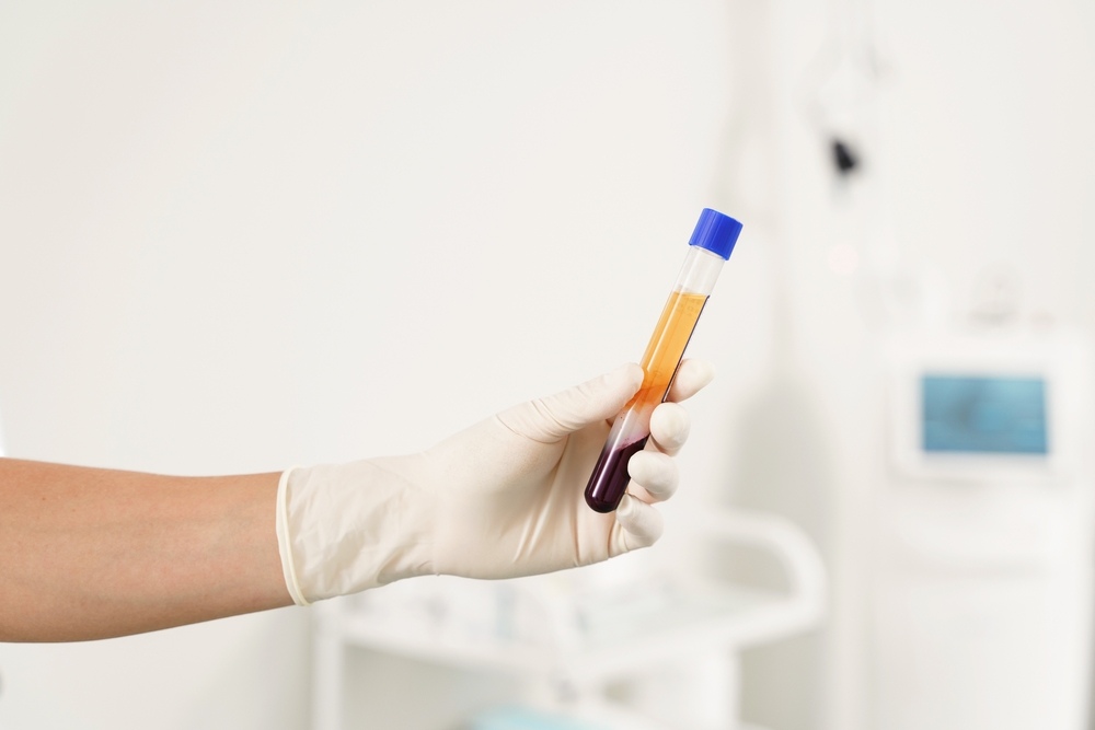 Gloved hand holding a test tube with separated blood components, red and yellow plasma, in a clinical setting.