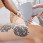 laser hair removal