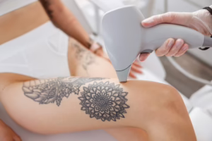 laser hair removal
